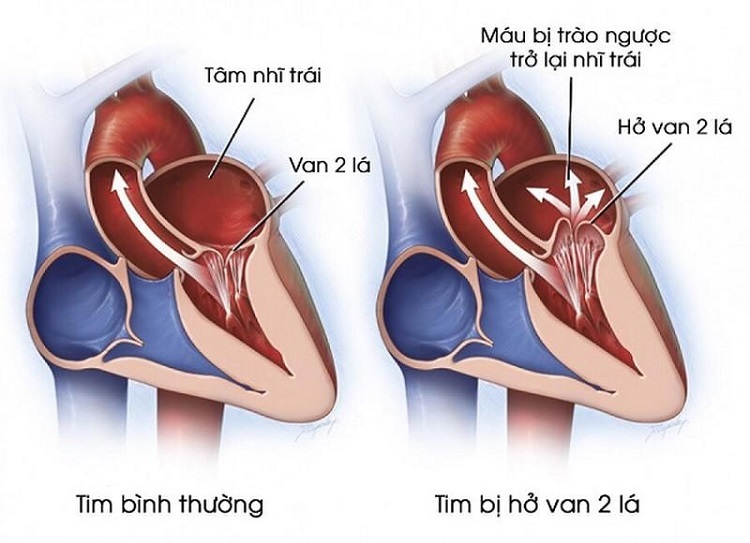 Toa Thuốc Hở Van 2 Lá và Van 4 Lá: Hướng Dẫn Chi Tiết Toa Thuốc Hở Van 2 Lá và Van 4 Lá: Hướng Dẫn Chi Tiết