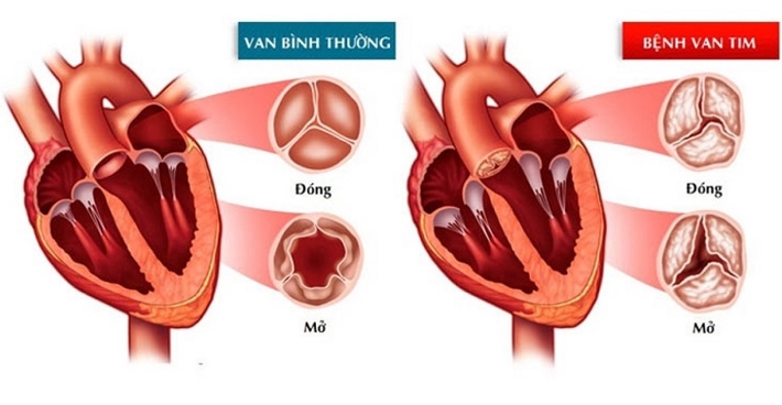 Toa Thuốc Hở Van 2 Lá và Van 4 Lá: Hướng Dẫn Chi Tiết