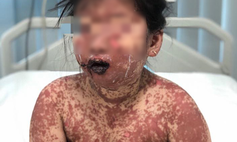 Thuốc Tắm Dành Cho Người Bị Bệnh Lở Loét Da: Hướng Dẫn Toàn Diện
