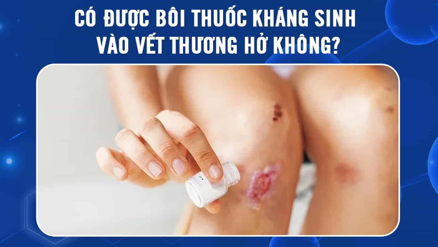 Dùng thuốc kháng sinh khi bị nhiễm trùng vết thương: Hướng dẫn chi tiết
