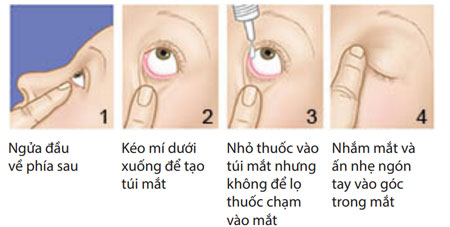 Tại Sao Không Để Thuốc Nhỏ Mắt Chạm Vào Mi: Hướng Dẫn Chi Tiết