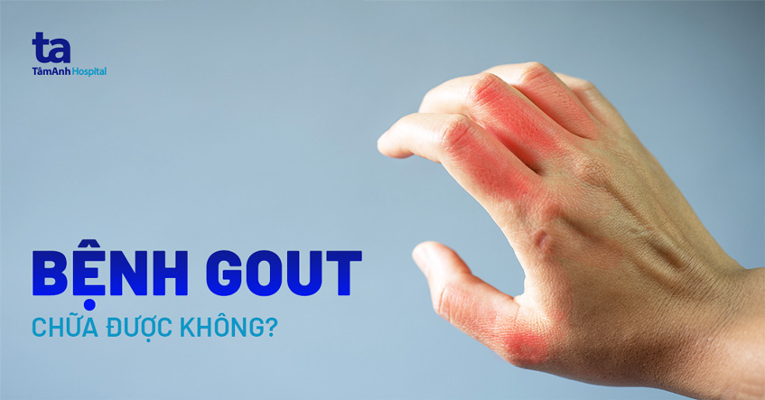 Khi Cơn Đau Gout Cấp: Lựa Chọn Thuốc Tây Điều Trị Hiệu Quả Khi Cơn Đau Gout Cấp: Lựa Chọn Thuốc Tây Điều Trị Hiệu Quả