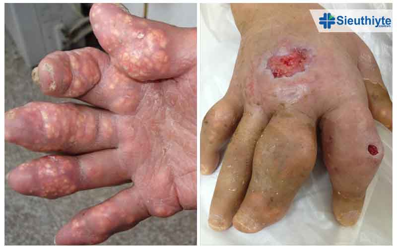Cách Làm Xẹp Cục Tophi Hiệu Quả và An Toàn