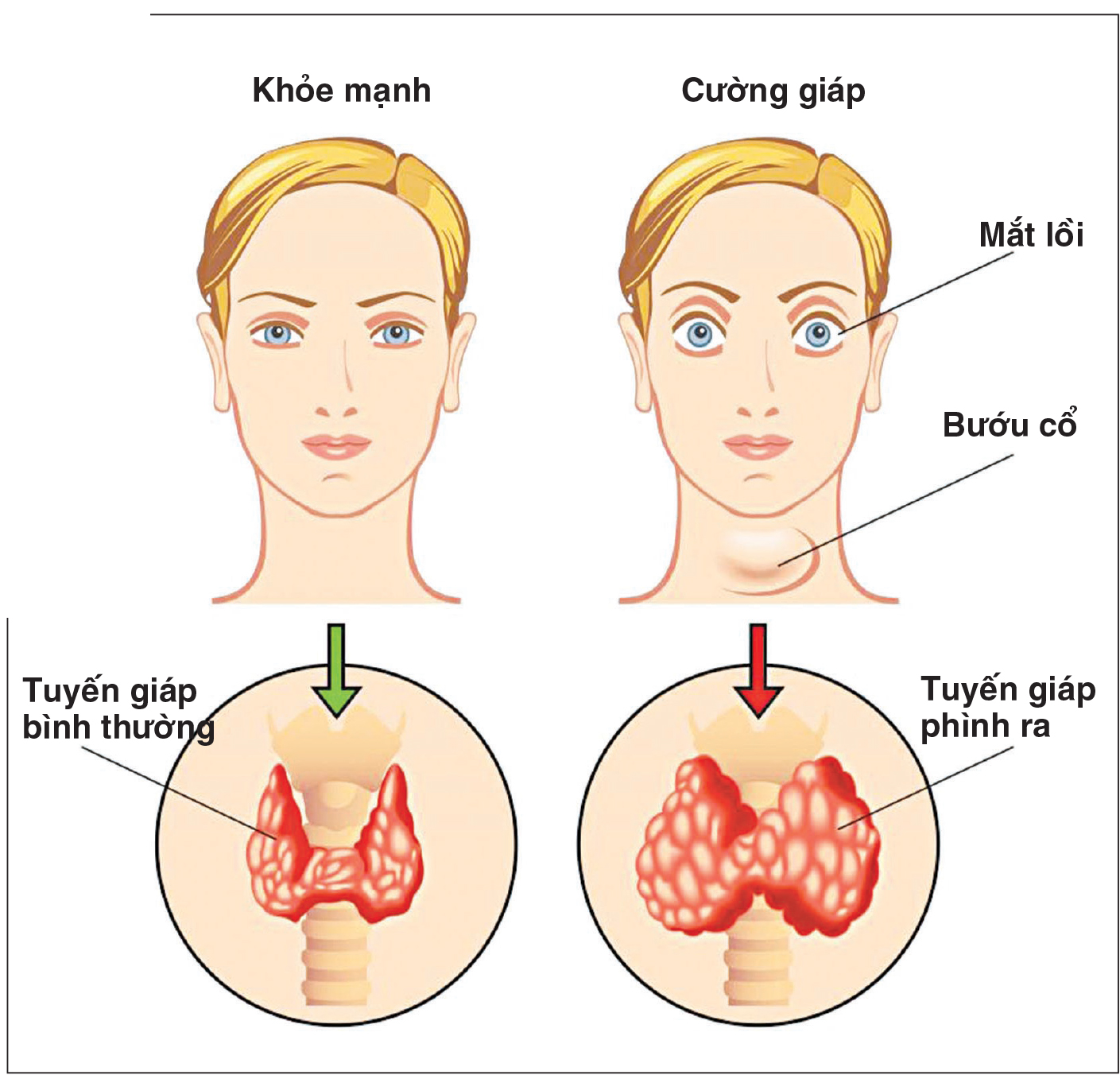 Đang Uống Thuốc Chữa Bướu Cổ Bị Cảm Cúm: Hướng Dẫn Xử Lý An Toàn