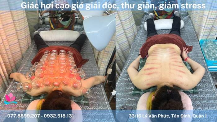 Đồ Giác Hơi: Giải Pháp Chăm Sóc Sức Khỏe Toàn Diện Tại Nhà