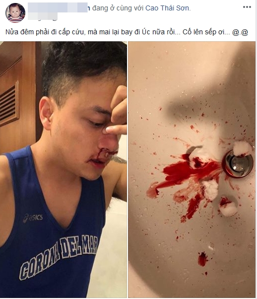 Vỡ Mạch Máu Mũi Là Gì: Nguyên Nhân, Cách Xử Lý và Phòng Ngừa Hiệu Quả