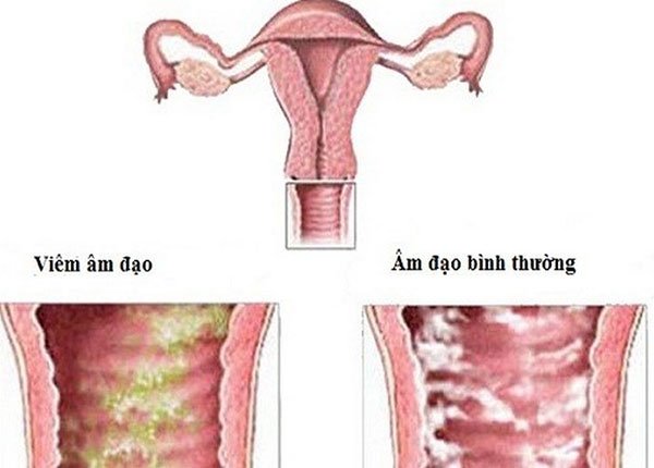 Điều Trị Viêm Âm Hộ Do Nhiễm Trùng Roi: Hướng Dẫn Chi Tiết và Hiệu Quả