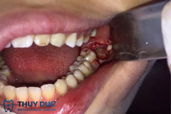 Nhổ Răng An Toàn Cho Bệnh Nhân Dùng Thuốc Chống Đông Nhổ Răng An Toàn Cho Bệnh Nhân Dùng Thuốc Chống Đông