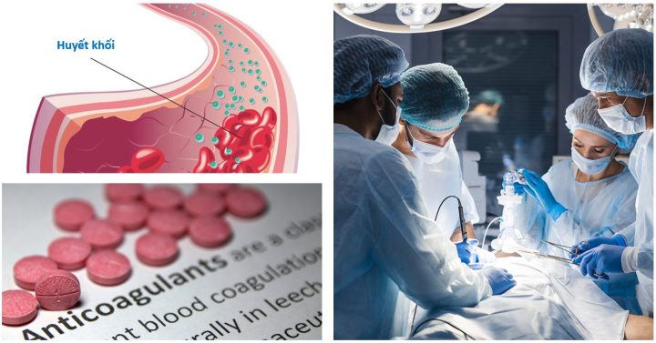 Nguy cơ huyết khối và xuất huyết trong phẫu thuật ở bệnh nhân dùng thuốc chống đông