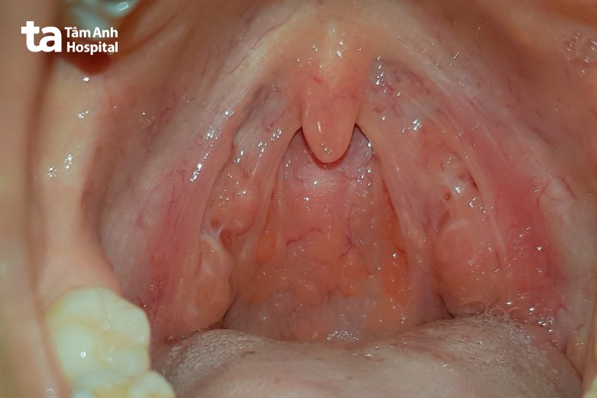 Dùng Thuốc Tây Khó Chữa Dứt Điểm Viêm Họng Hạt: Giải Pháp Toàn Diện