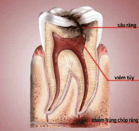 Răng Bị Lung Lay Sau Khi Đặt Thuốc Diệt Tủy: Nguyên Nhân và Cách Xử Lý