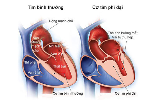 Các Loại Thuốc Điều Trị Bệnh Cơ Tim Phì Đại: Hướng Dẫn Chi Tiết Các Loại Thuốc Điều Trị Bệnh Cơ Tim Phì Đại: Hướng Dẫn Chi Tiết