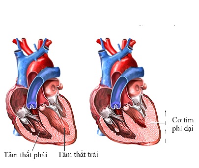 Các Loại Thuốc Điều Trị Bệnh Cơ Tim Phì Đại: Hướng Dẫn Chi Tiết Các Loại Thuốc Điều Trị Bệnh Cơ Tim Phì Đại: Hướng Dẫn Chi Tiết