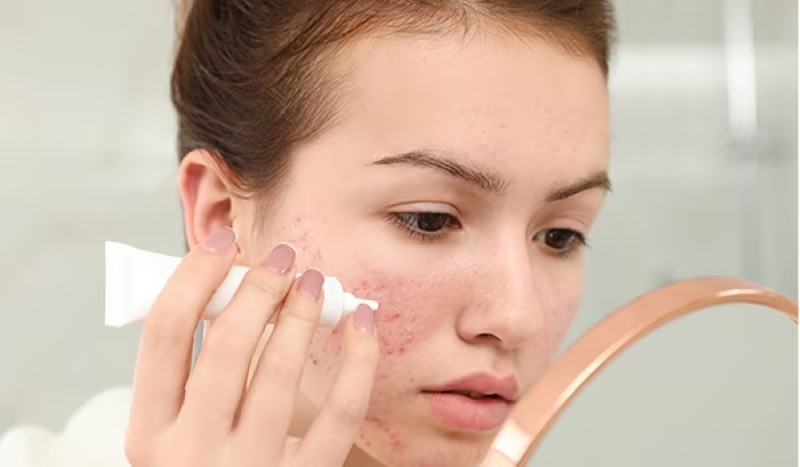 Bôi Thuốc Trị Mụn Lúc Mụn Như Thế Nào Là Đúng Cách Để Đạt Hiệu Quả Tối Ưu