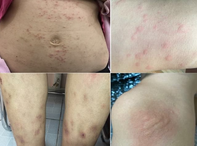 Dấu hiệu nhận biết các bệnh giun sán và phản ứng dị ứng sau khi dùng thuốc