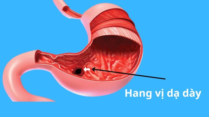 Thuốc Điều Trị Viêm Xung Huyết Hang Vị Dạ Dày Hiệu Quả Và An Toàn