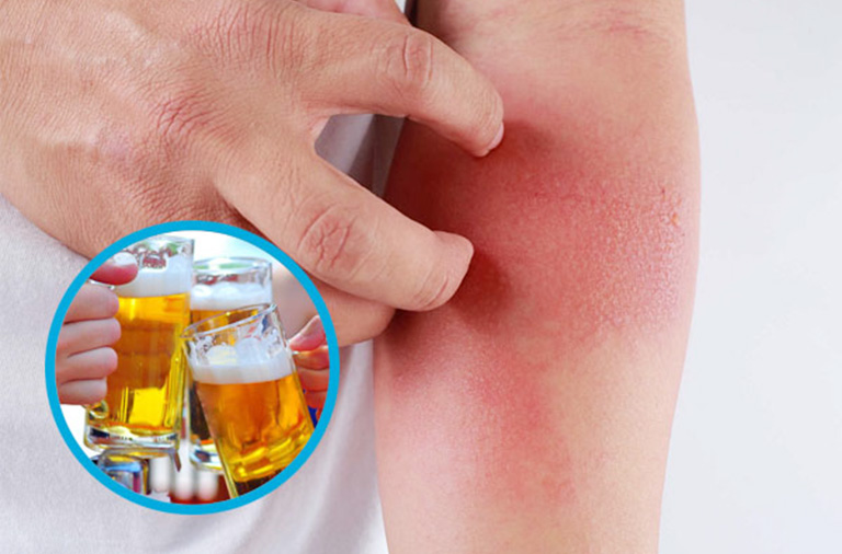 Cô gái dùng rượu thuốc 2 tuần bị dị ứng: Hiểu rõ nguy cơ & xử trí kịp thời