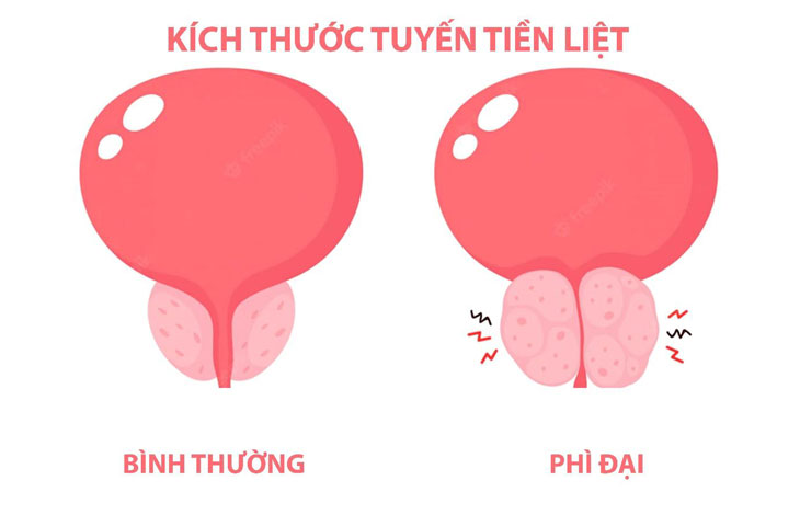 Các Loại Thuốc Điều Trị Phì Đại Tuyến Tiền Liệt Hiệu Quả Hiện Nay