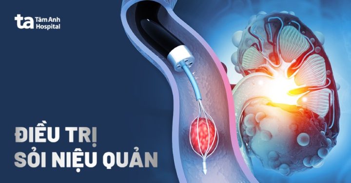 Sỏi Niệu Quản Uống Thuốc Nam: Phân Tích Khoa Học & Giải Pháp Toàn Diện