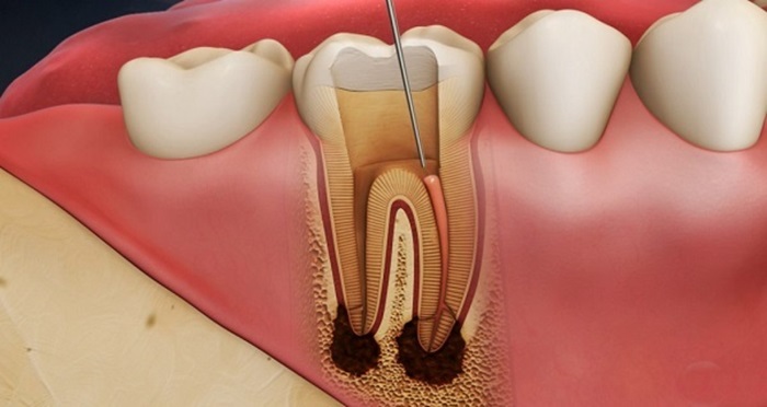 Minh họa các loại răng ảnh hưởng đến chi phí điều trị tủy