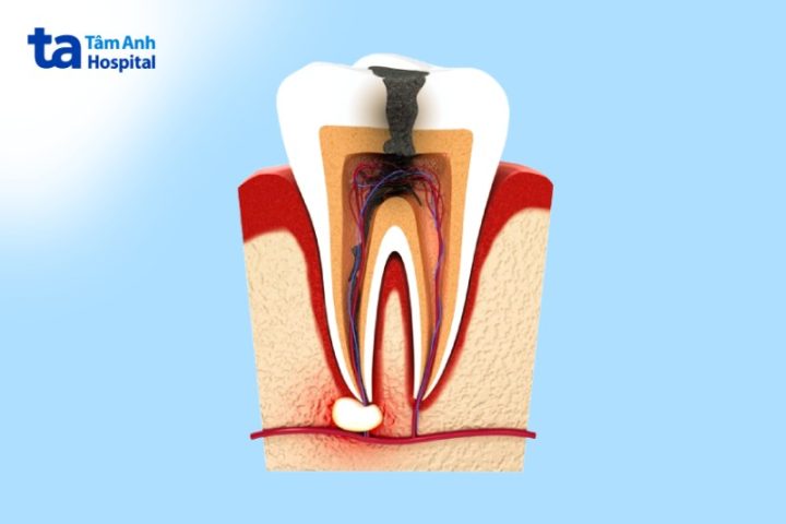 Hình ảnh thực tế quá trình điều trị tủy răng tại phòng khám nha khoa