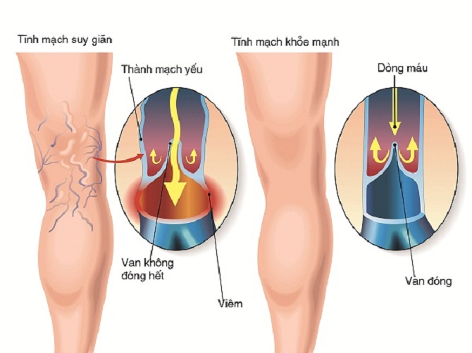 Cách Làm Hết Giãn Tĩnh Mạch: Giải Pháp Hiệu Quả Từ Chuyên Gia Cách Làm Hết Giãn Tĩnh Mạch: Giải Pháp Hiệu Quả Từ Chuyên Gia