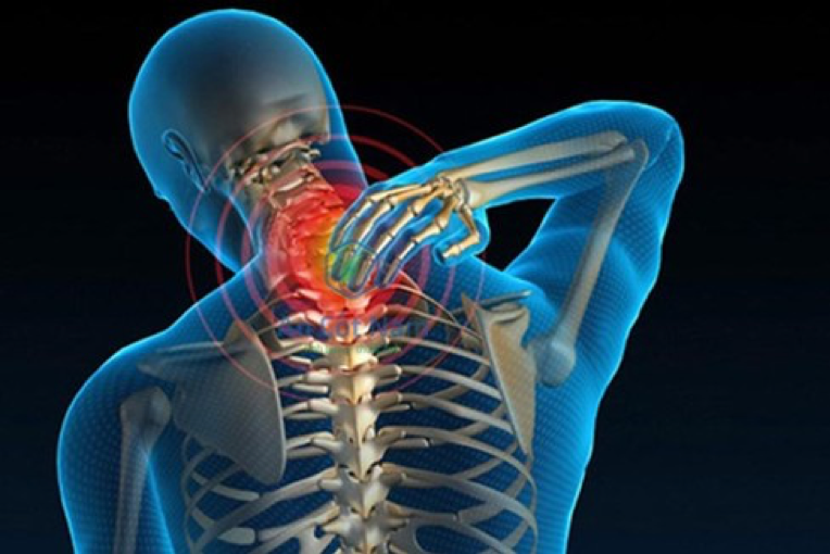 Thuốc điều trị thoái hóa cột sống cổ là gì: Giải pháp và những điều cần biết