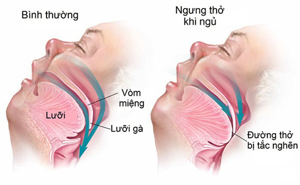 Thiết Bị Chống Ngáy: Giải Pháp Toàn Diện Cho Giấc Ngủ Ngon