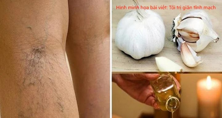 Tỏi Trị Giãn Tĩnh Mạch: Sự Thật Khoa Học & Cách Dùng An Toàn Tỏi Trị Giãn Tĩnh Mạch: Sự Thật Khoa Học & Cách Dùng An Toàn