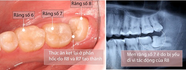 Mọc Răng Số 8 Hàm Dưới: Nguyên Nhân, Biến Chứng và Giải Pháp Điều Trị