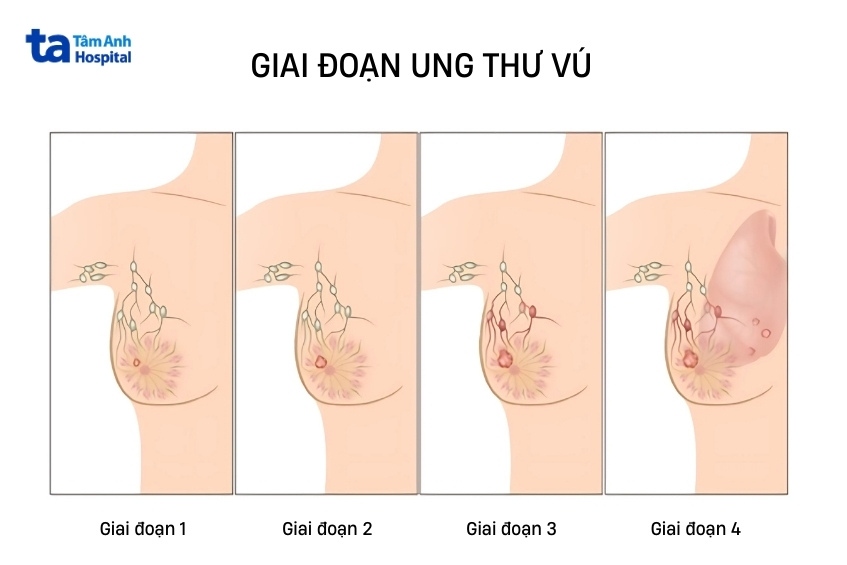 Ra Thuốc Cho Bệnh Nhân Ung Thư Thời Kỳ Cuối: Hướng Dẫn Toàn Diện