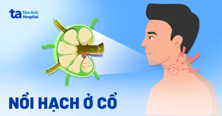 Cổ họng nổi gân máu: Nguyên nhân và cách điều trị hiệu quả Cổ họng nổi gân máu: Nguyên nhân và cách điều trị hiệu quả