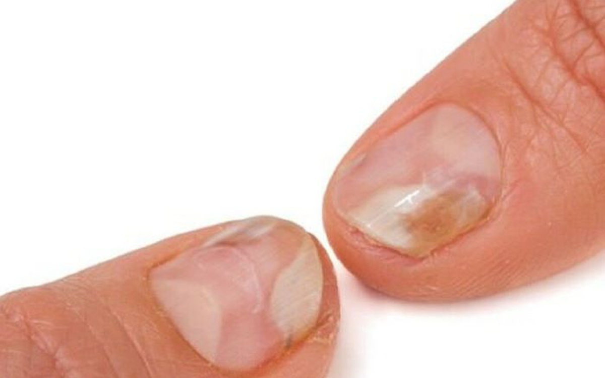 Thuốc Bôi Viêm Quanh Móng Tay Do Bị Trầy Xước: Hướng Dẫn Toàn Diện