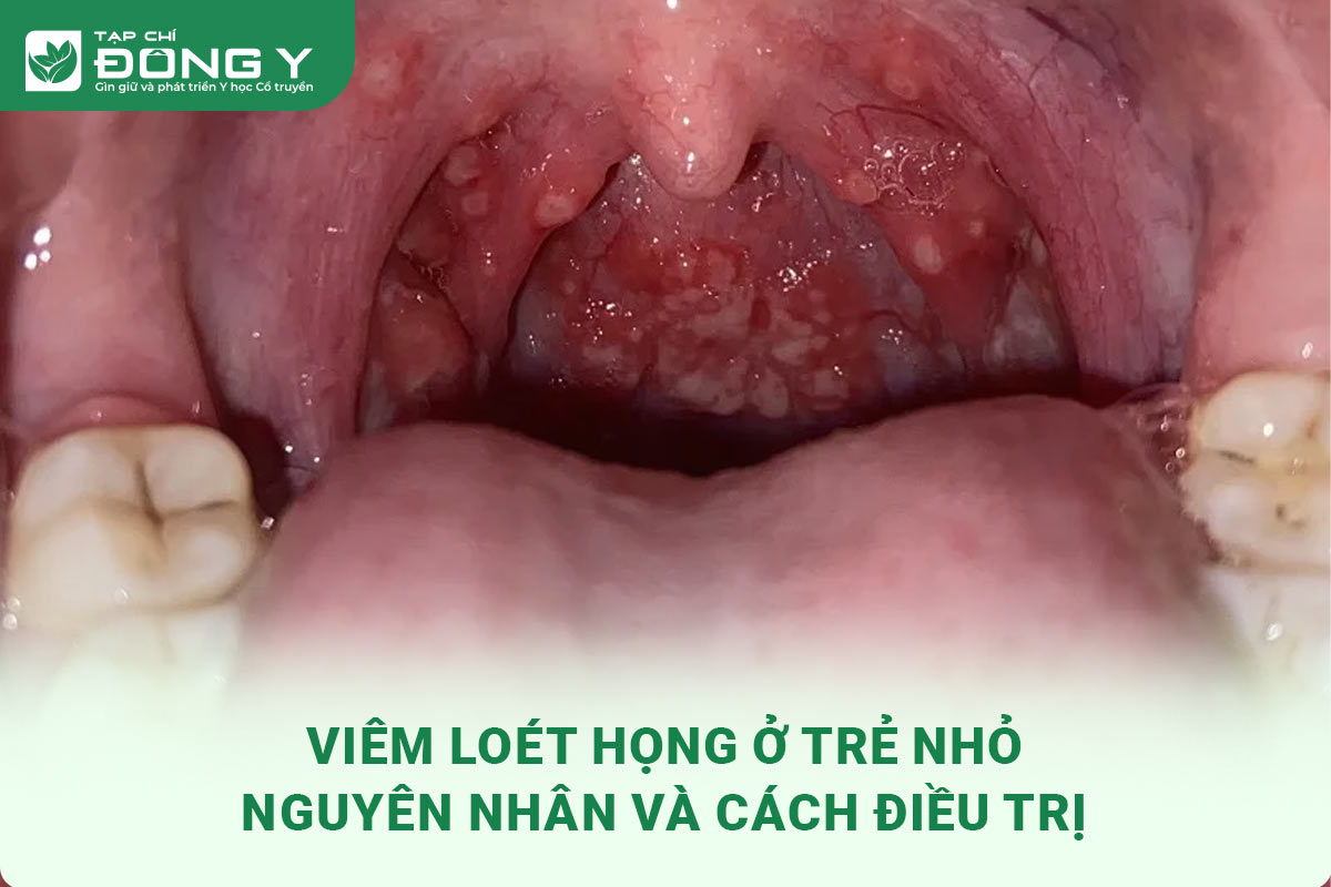 Em Bé Bị Đau Họng Ho Đờm Đã Uống Thuốc: Khi Nào Cần Lo Lắng Và Phải Làm Gì?