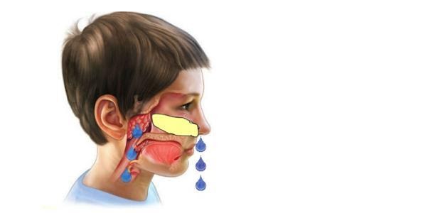 Thuốc Điều Trị Viêm Mũi Dị Ứng ở Trẻ Em: Hướng Dẫn Chi Tiết Thuốc Điều Trị Viêm Mũi Dị Ứng ở Trẻ Em: Hướng Dẫn Chi Tiết