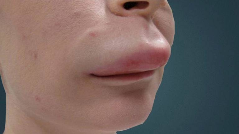 Đã Uống Thuốc Kháng Histamin Nhưng Vẫn Bị Phù Quincke: Điều Trị và Giải Pháp