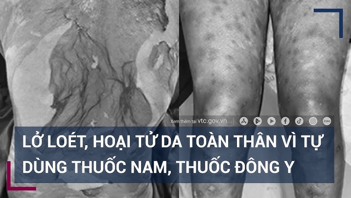 Thuốc Tắm Dành Cho Người Bị Bệnh Lở Loét Da: Hướng Dẫn Toàn Diện