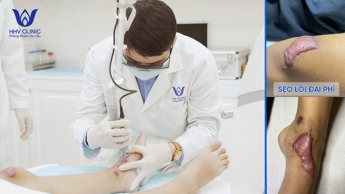 Vết Thương Mới Lành: So Sánh Thuốc Trị Sẹo Và Nghệ Để Có Lựa Chọn Tốt Nhất