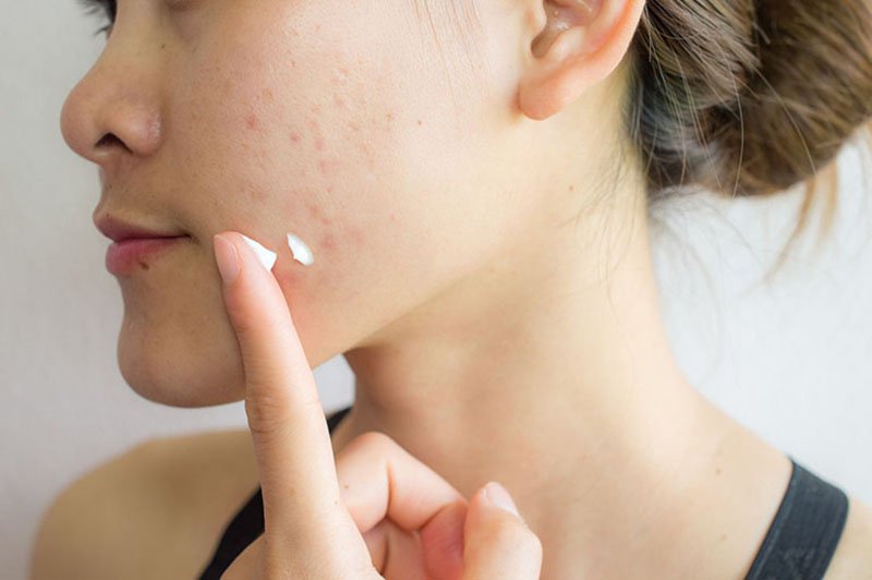 Bôi Thuốc Trị Mụn Lúc Mụn Như Thế Nào Là Đúng Cách Để Đạt Hiệu Quả Tối Ưu