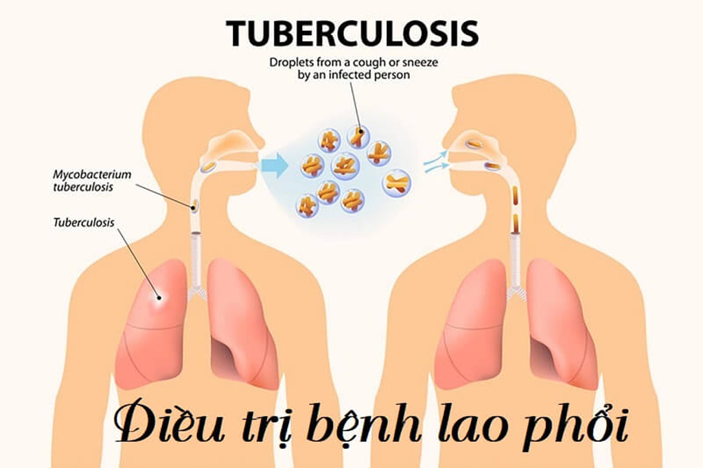 Bệnh Lao Kháng Thuốc Sau Bao Lâu Thì Hết Lây: Hướng Dẫn Chi Tiết