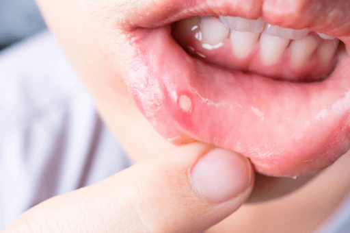 Thuốc Điều Trị Bệnh Chân Tay Miệng Ở Trẻ Em: Hướng Dẫn Chi Tiết