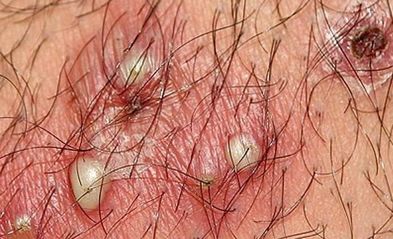 Bôi Thuốc Bị Rát Vùng Hơi Màu Trắng: Nguyên Nhân & Xử Lý