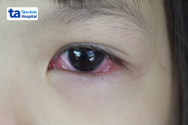 Thuốc Không Nên Dùng Cho Bệnh Viêm Kết Mạc: Hướng Dẫn Chi Tiết Từ Chuyên Gia