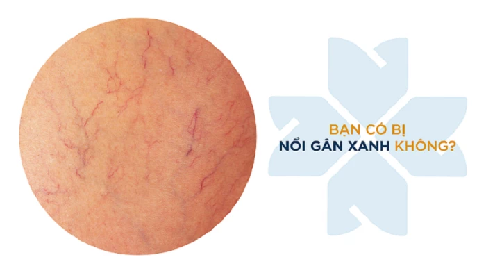 Cấu tạo tĩnh mạch và các yếu tố dẫn đến tình trạng nổi gân xanh