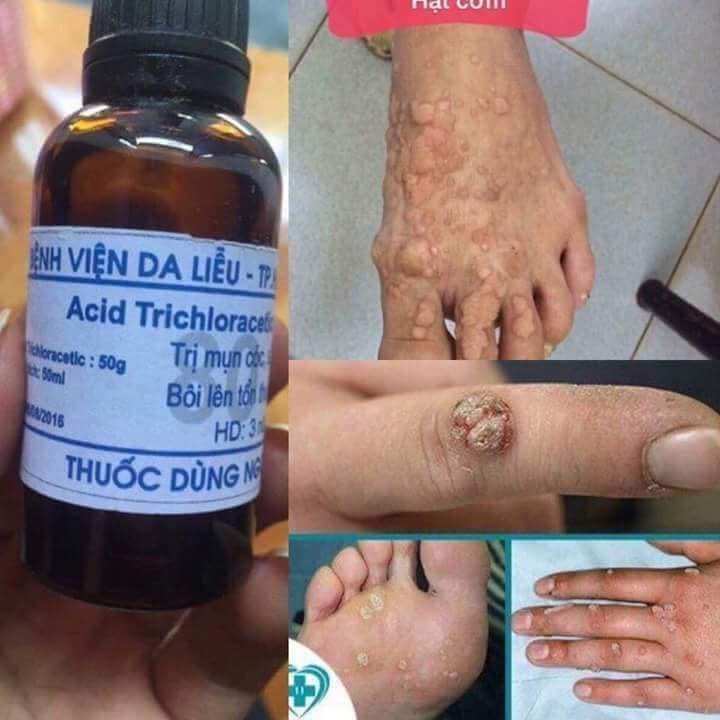 Chữa Mụn Cóc Triệt Để Bằng Bài Thuốc Dân Gian: Giải Pháp Tự Nhiên