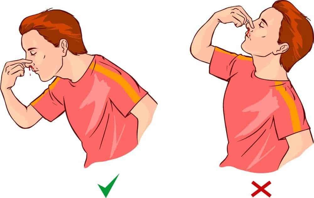 Bài Thuốc Chảy Máu Cam Của Bác Sĩ Hùng Y: Tìm Hiểu Chuyên Sâu Và Lời Khuyên Y Tế