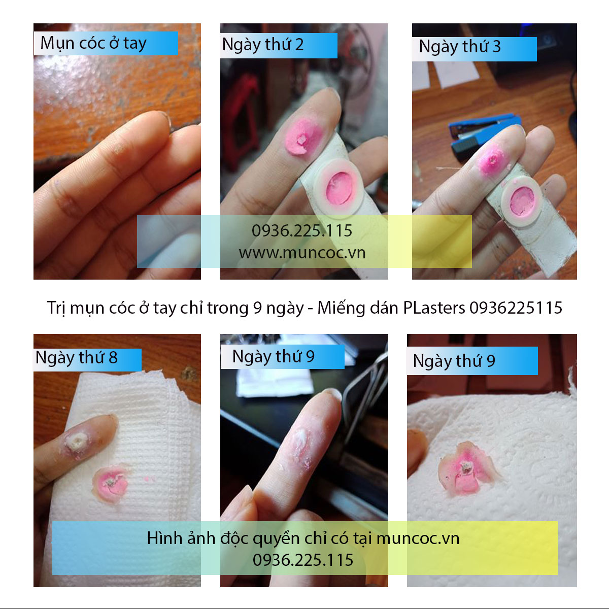 Miếng Dán Plaster Trị Mụn Cơm: Tìm Mua Tại Nhà Thuốc Tây Sơn Miếng Dán Plaster Trị Mụn Cơm: Tìm Mua Tại Nhà Thuốc Tây Sơn