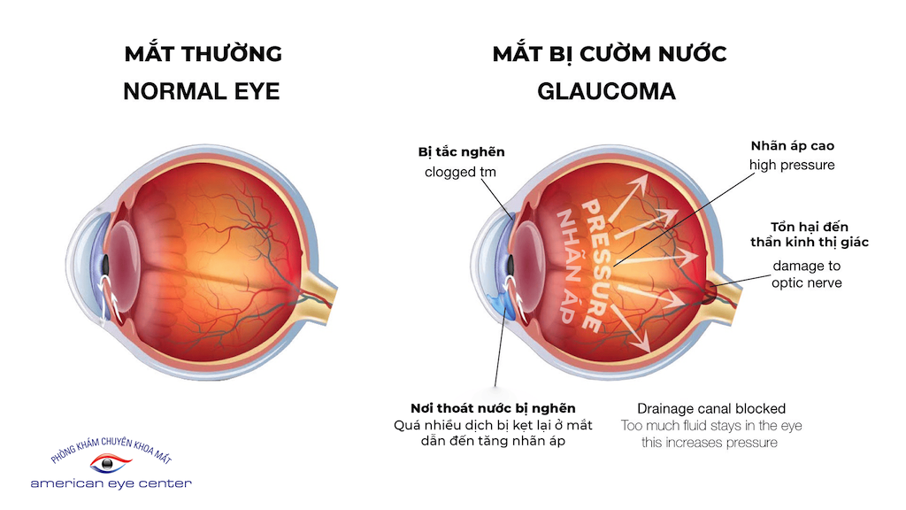 Toa Thuốc Điều Trị Sau Khi Phẫu Thuật Cườm Nước: Hướng Dẫn Chi Tiết