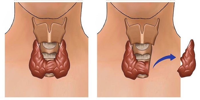 Khi nào mổ tuyến giáp phải uống thuốc dài ngày và lý do