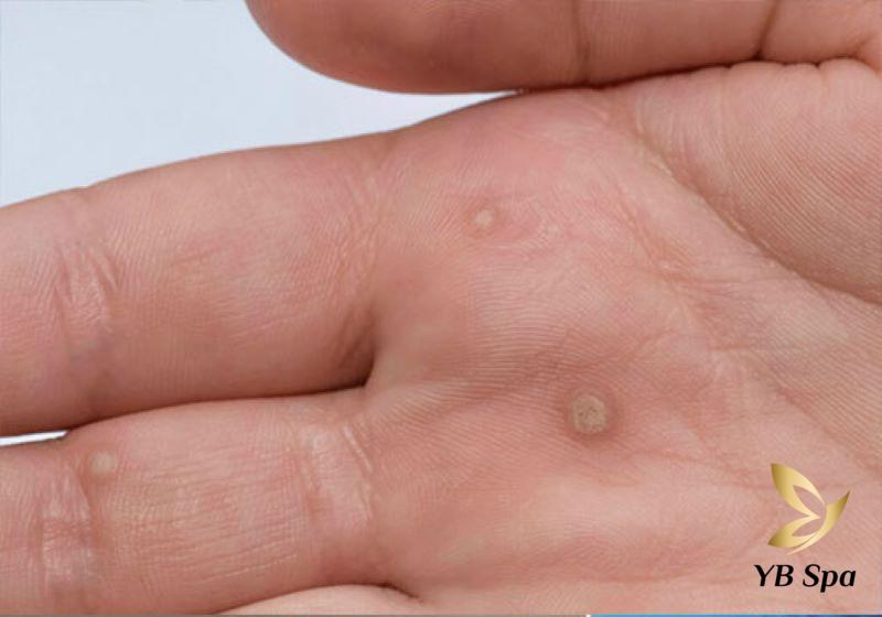 Chữa Mụn Cóc Triệt Để Bằng Bài Thuốc Dân Gian: Giải Pháp Tự Nhiên
